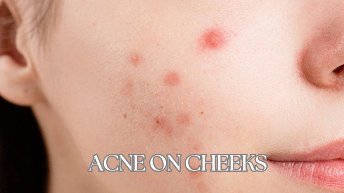 Acne on Cheeks